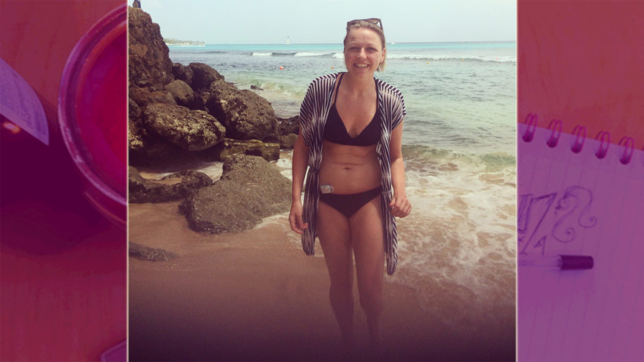 Girl standing on a beach wearing a bikini and an insulin pump
