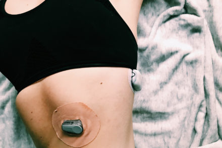 Torso showing an insulin pump and a continuous glucose monitor on a body